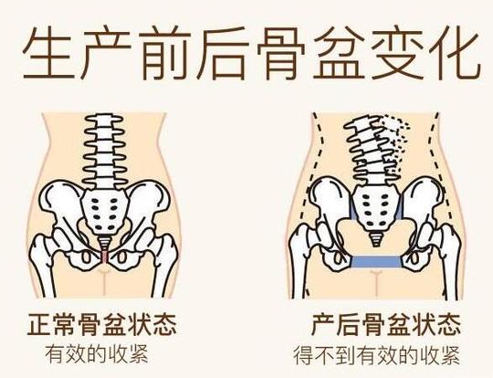 产后骨盆修复