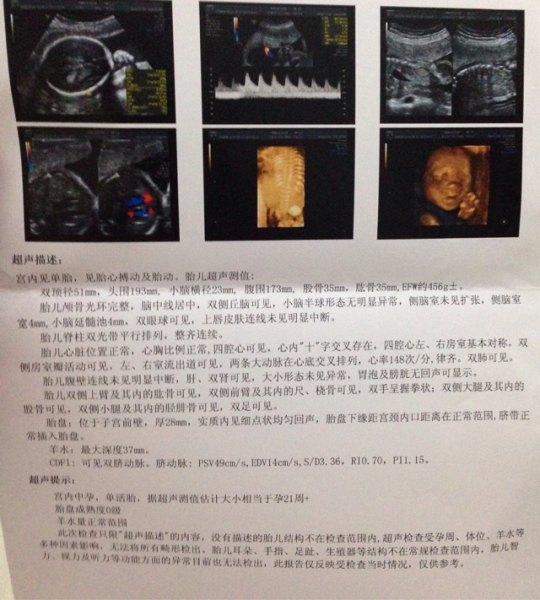 四维彩超怎么能分辨男女