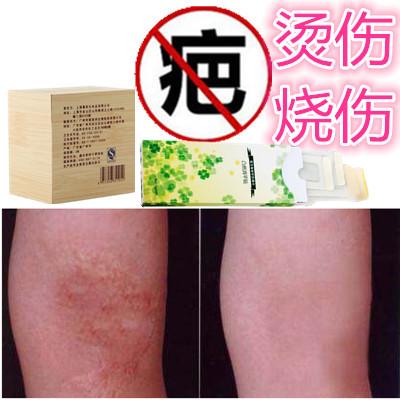 宝宝长冻疮用什么好得快