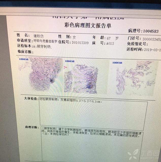 长期咳嗽会是肺癌吗