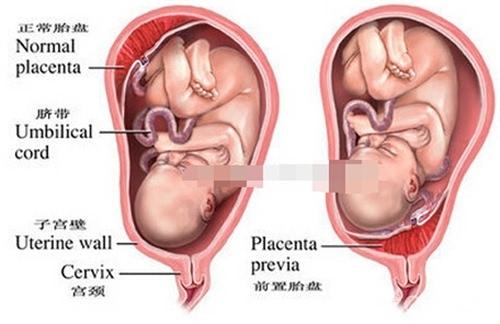 预防胎盘前置的方法