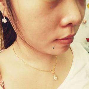 哪些部位的痣需要切除