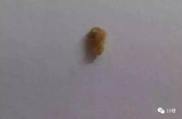 肾结石多喝水能排掉吗