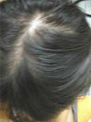 宝宝掉头发是怎么回事?