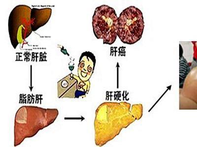 婴儿感染上乙肝有哪些症状表现