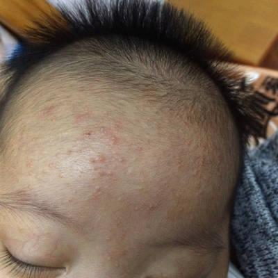 小儿湿疹和热疹有什么区别