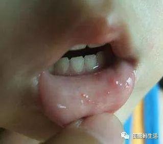 什么是鹅口疮