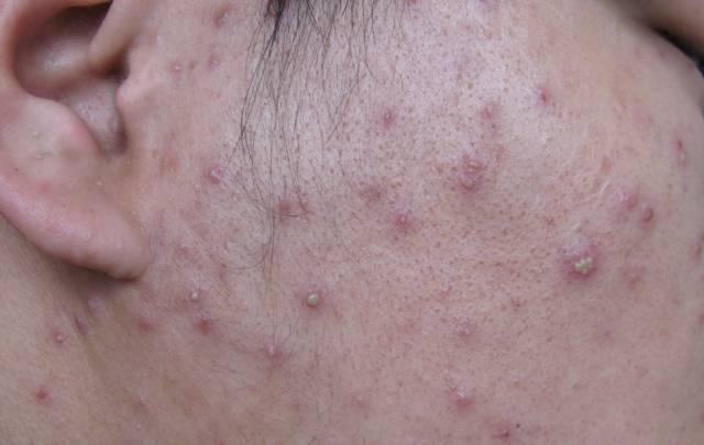 宝宝长了传染性软疣怎么办