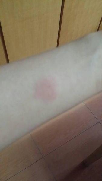 肺结核病最常见的症状有哪些