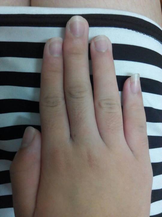 右手中指左边都不长肉了,该怎么办.而且中指因为写字