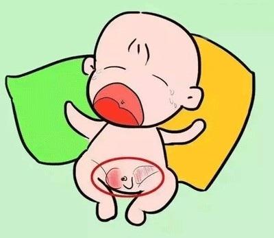 小儿疝气怎么治疗