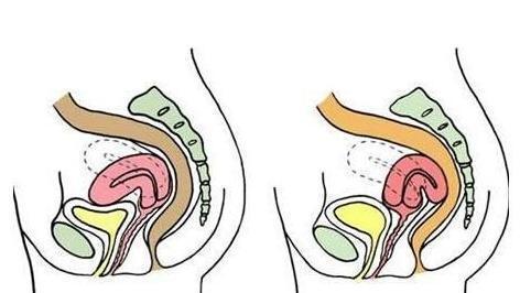 子宫后位月经不调