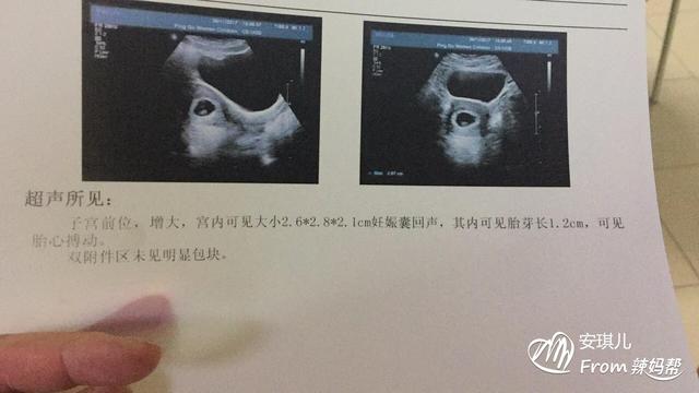 有胎心胎芽为什么胎停育了