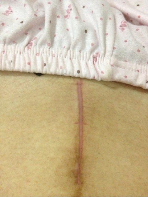 剖腹产产后伤口增生怎么办