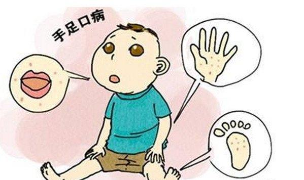 手足口病好了多久不会传染呢