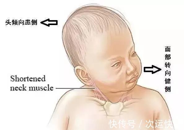 宝宝头总往一边偏是斜颈吗