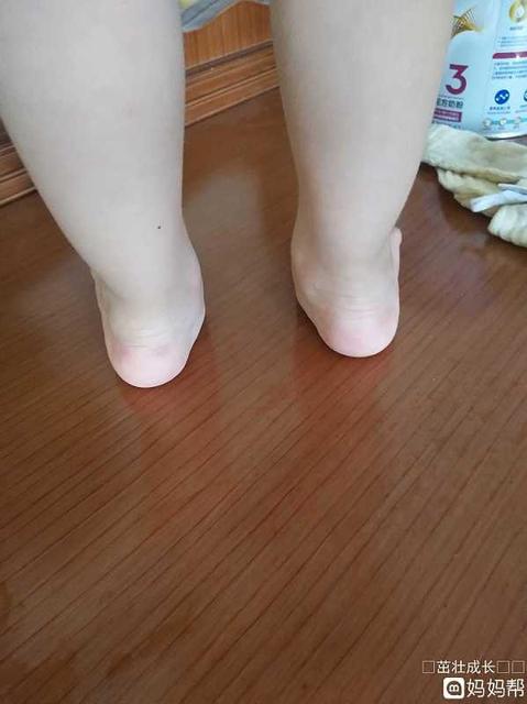 宝宝足外翻是什么样子的图片