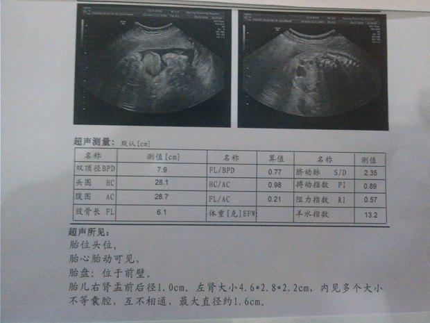 怀孕时候肾积水会不会有后遗症