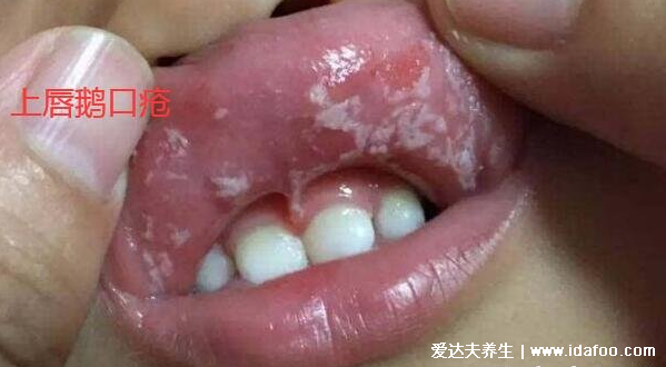 宝宝嘴里有白色的东西是鹅口疮吗