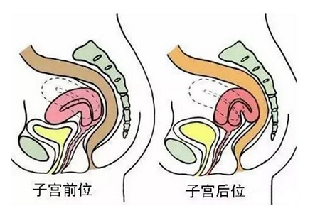 子宫后位的影响有哪些