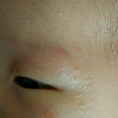 天气热宝宝身上起红点怎么办