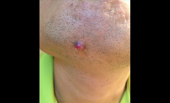 下巴容易长痘痘是什么原因引起的