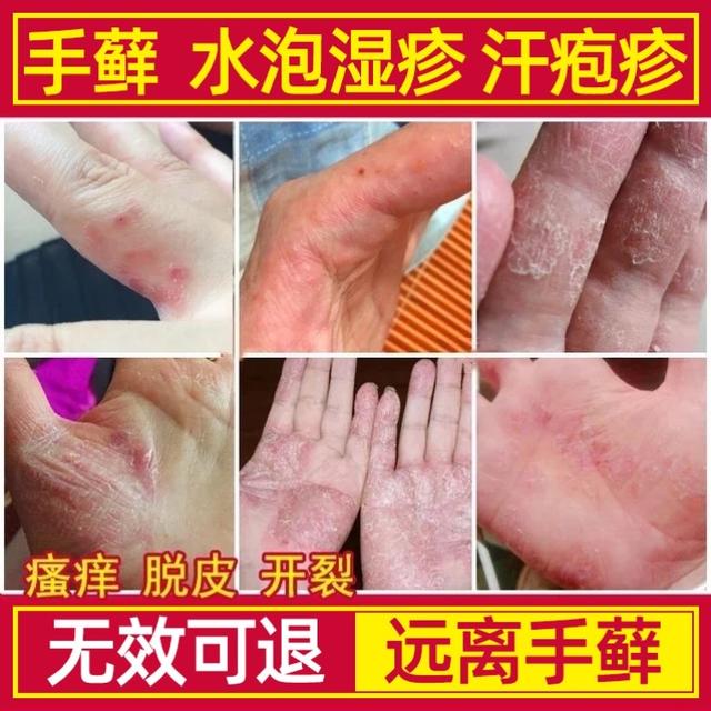 婴儿湿疹可以用好孩子药膏吗