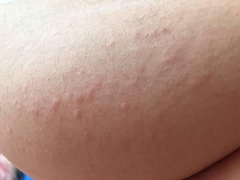 小孩身上老是过敏怎么办