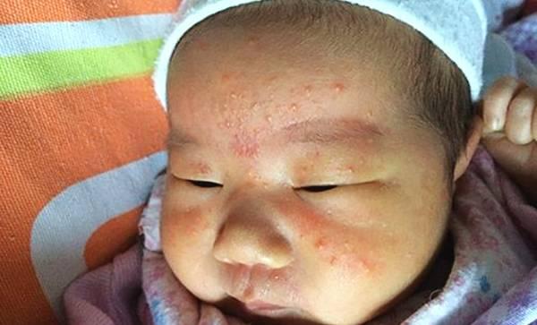 孕妇吃鹅蛋真的可以去胎毒和黄疸吗