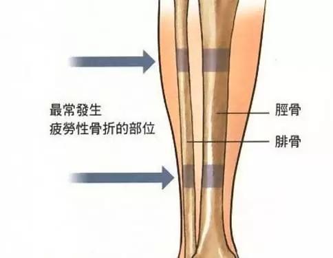 孩子步态异常怎么知道