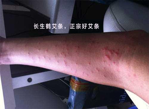 小儿荨麻疹不能吃什么食物