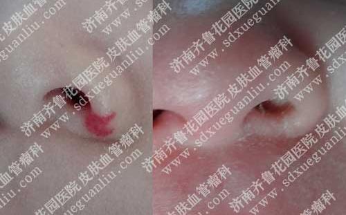 济南齐鲁花园医院皮肤血管瘤科对于婴幼儿鼻孔处血管瘤治疗前后对比图