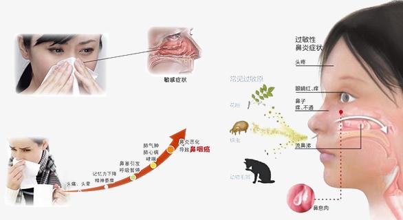 过敏性鼻炎的危害有哪些