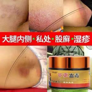 大腿内侧瘙痒的原因是什么?