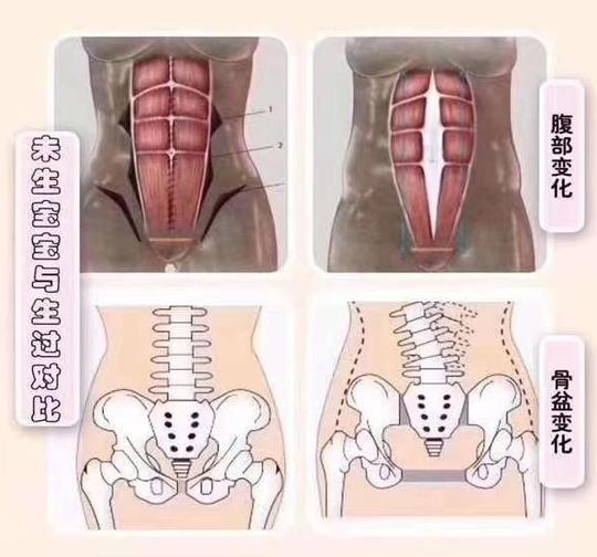 产后盆底肌修复