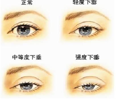 做完双眼皮手术会影响视力吗