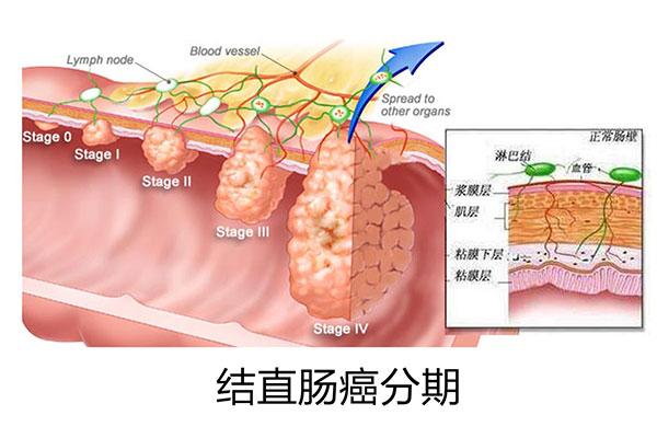 矮个子结直肠癌