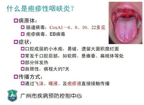 手足口病和疱疹性咽峡炎的区别表格