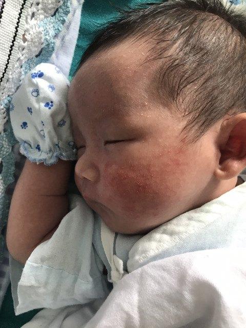 新生儿痤疮怎么治疗