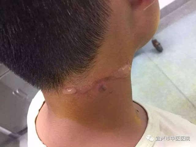 被隐翅虫叮咬了怎么办