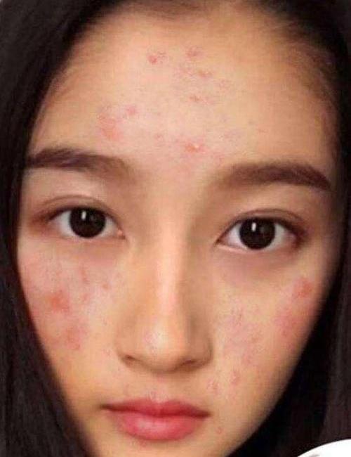满脸痘痘怎么办额头上长痘痘是什么原因