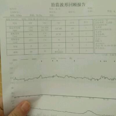 胎心监护宫缩压多少是要生了