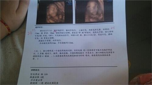 孕28周胎儿发育标准值