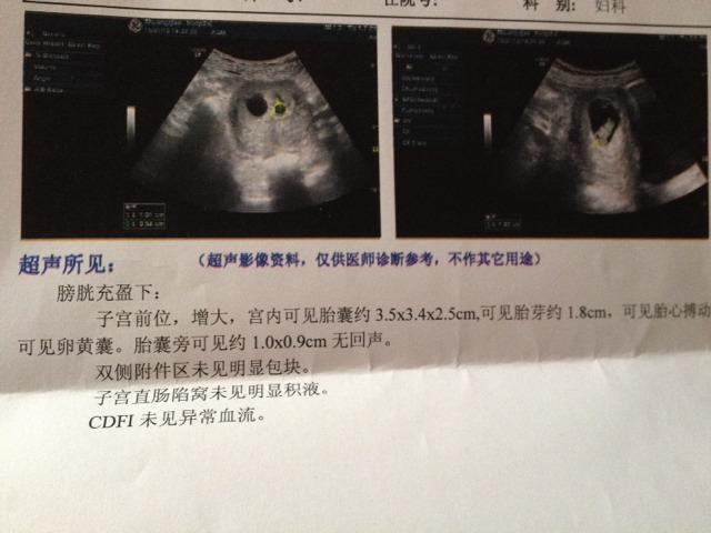 怀孕40多天b超看不到孕囊正常吗