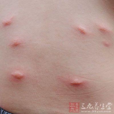 婴儿皮肤过敏怎么办最快方法