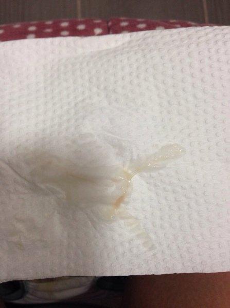 怀孕了分泌物有点血丝