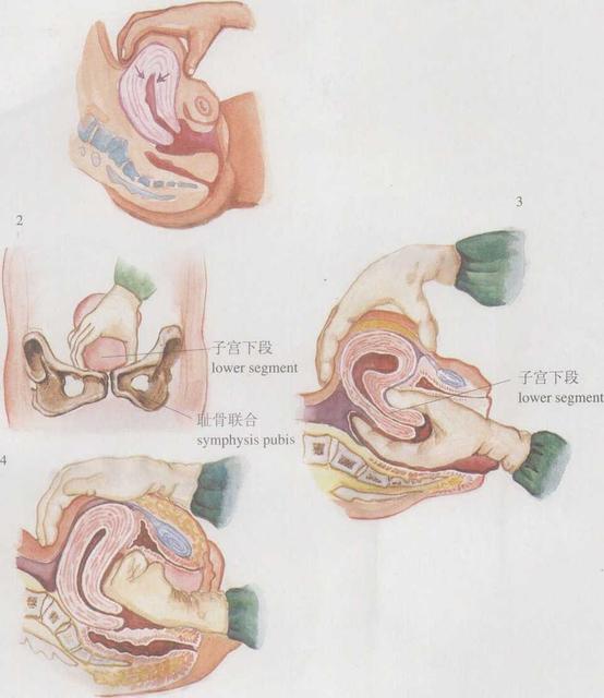 产后子宫按摩手法