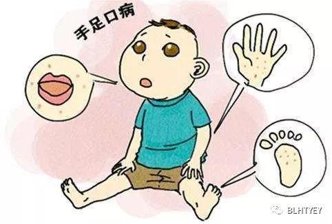 手足口病的传播途径及预防措施