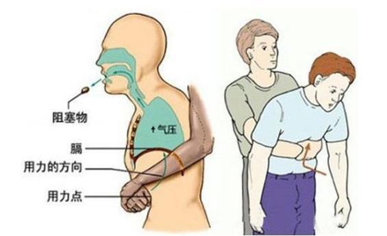 3岁宝宝异物卡喉急救