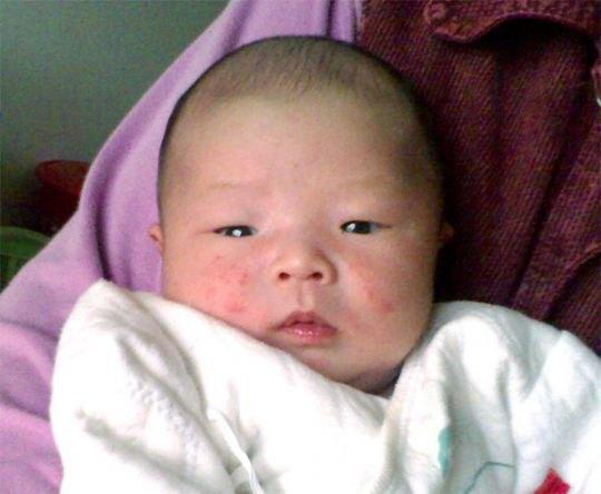 中药治疗宝宝湿疹有效果吗